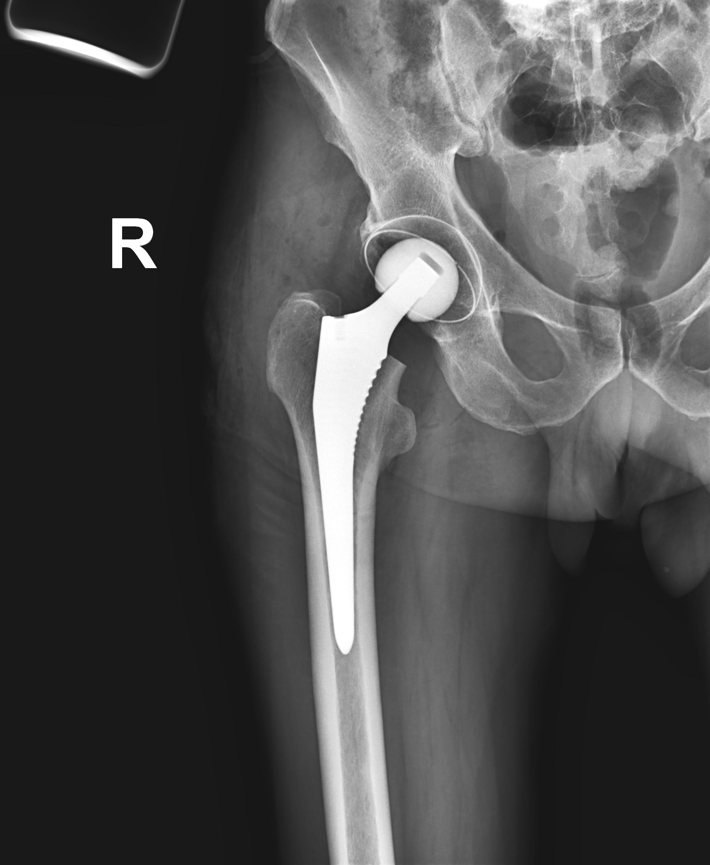 Эндопротезирование тазобедренного сустава