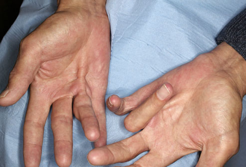 Контрактура Дюпютрена 