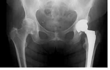 Эндопротезирование тазобедренного сустава