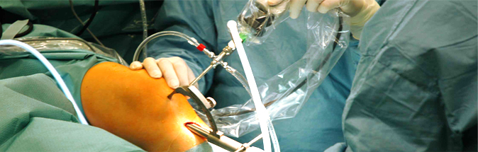 Артроскопия коленого сустава