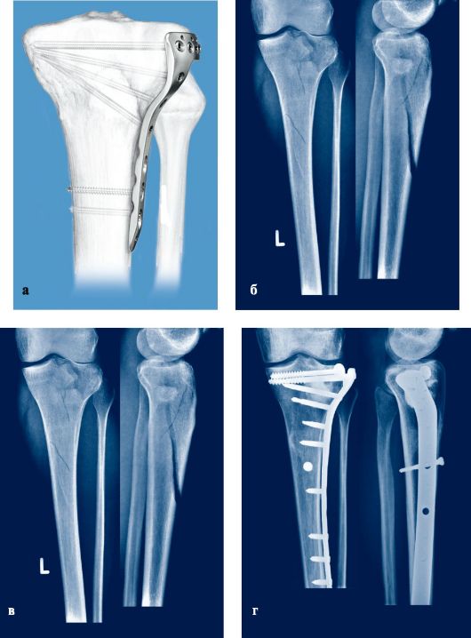 Лечение переломов всех локализаций и любой степени сложности