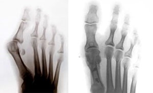 Лечение патологий стопы 